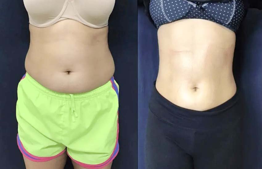 PhysiQ-before-and-after_01