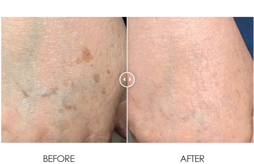 PicoLazer_beforeafter_02-web