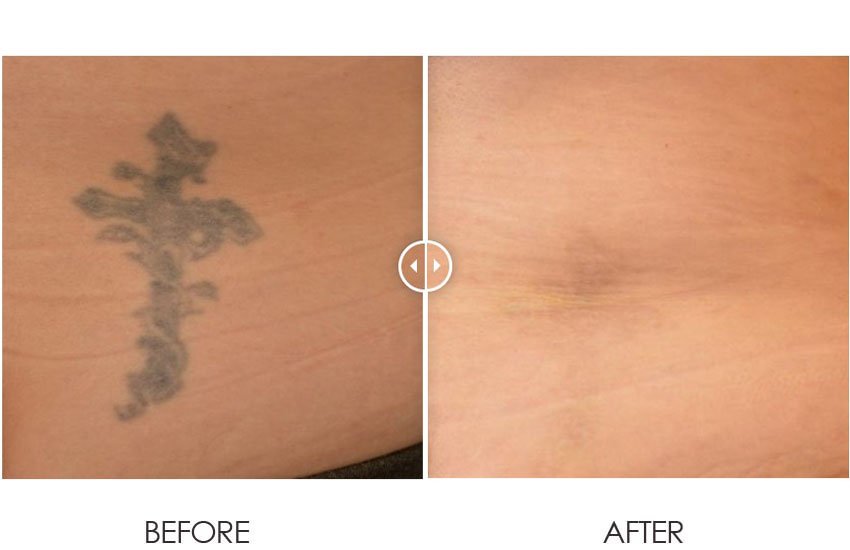 PicoLazer_beforeafter_03-web