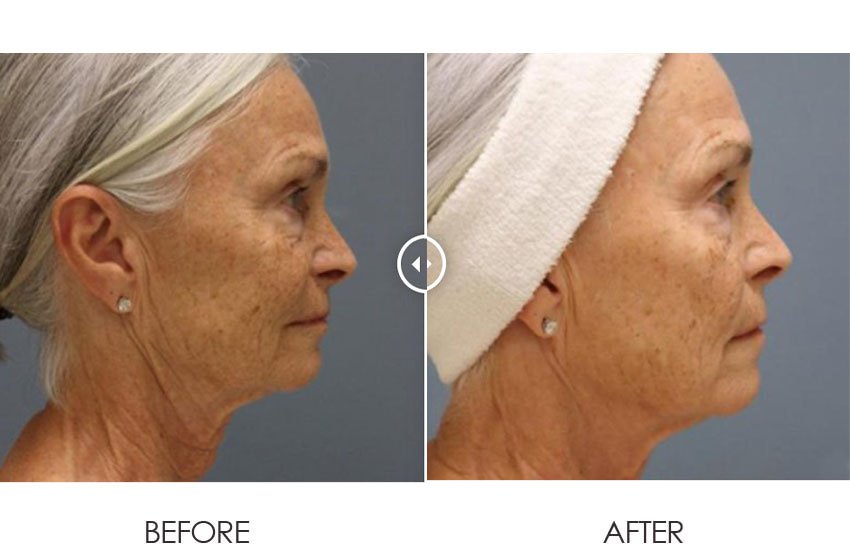 Pixel8-RF_beforeafter_02-web