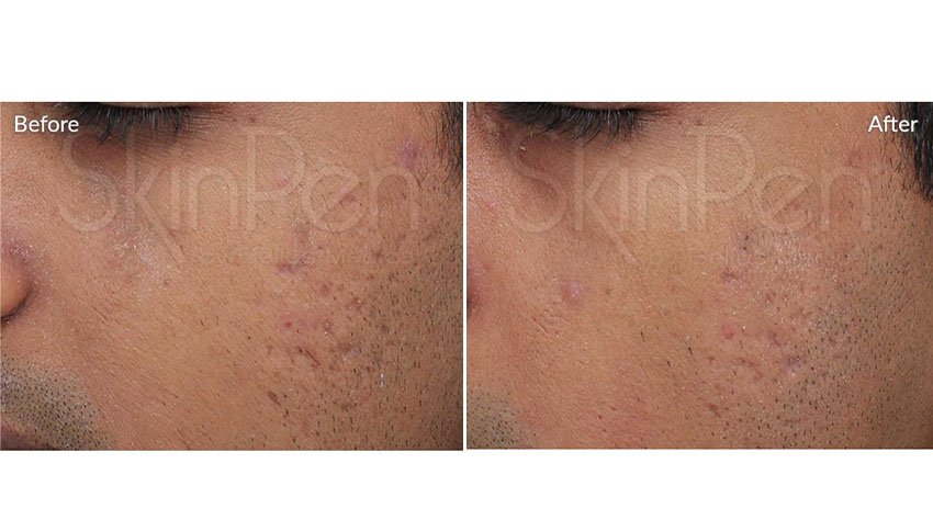SkinPen_beforeafter_01-web