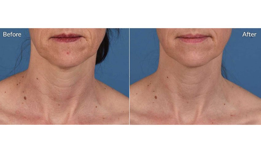 SkinPen_beforeafter_04-web